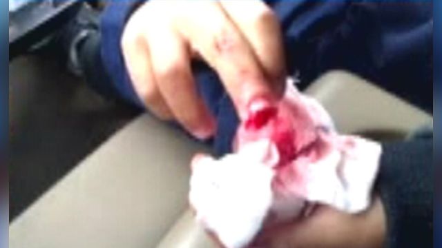 Third grader loses part of finger in classroom accident