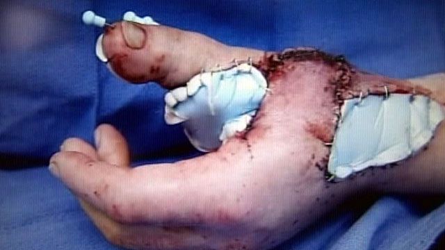 Doctors use big toe to replace lost thumb