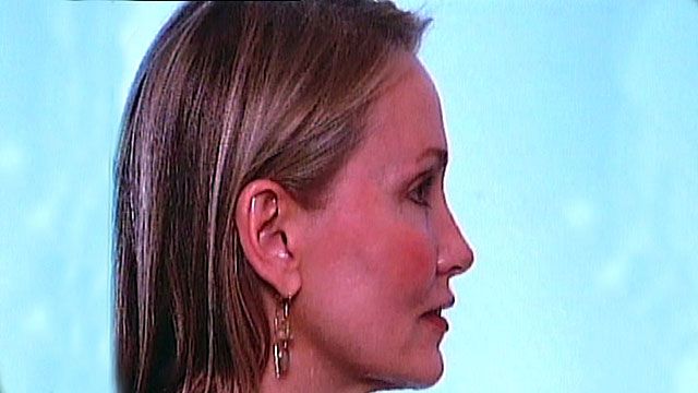 Study: Chin implants on the rise in US