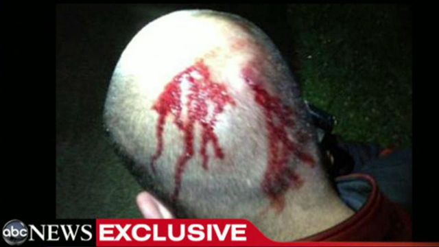Zimmerman's bloody head pics: A turning point in the case?