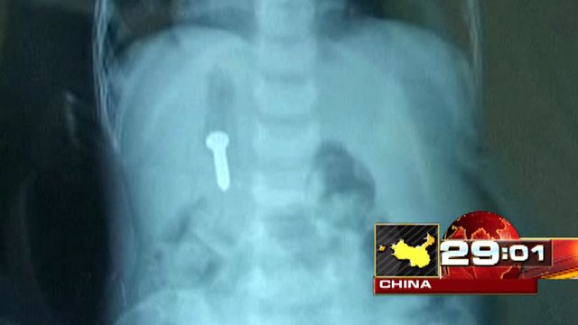 Around the World: Doctors remove screw from baby's stomach