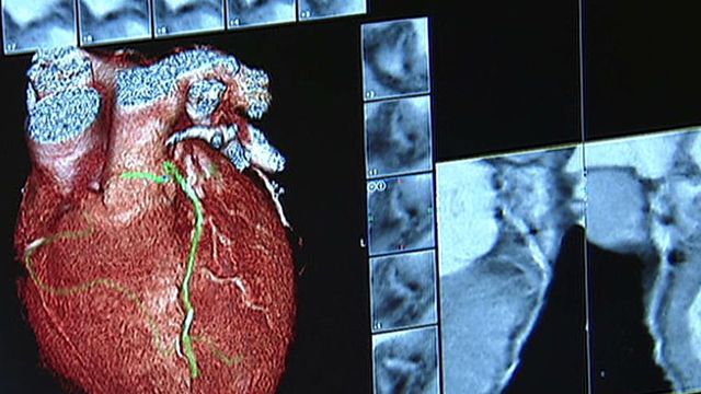 Study: Converting skin cells into healthy heart cells