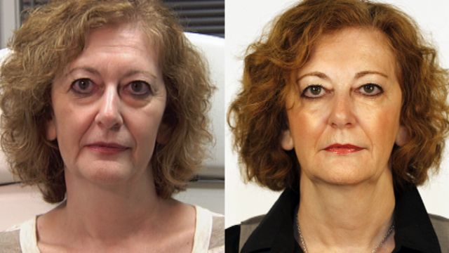 Watch a Liquid Facelift: Instant Results, No Knife