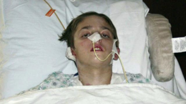 Trial for 'ringleader' in alleged burn attack on FL teen