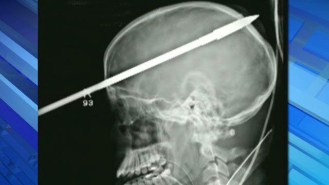 Teen shot with spear gun makes miraculous recovery