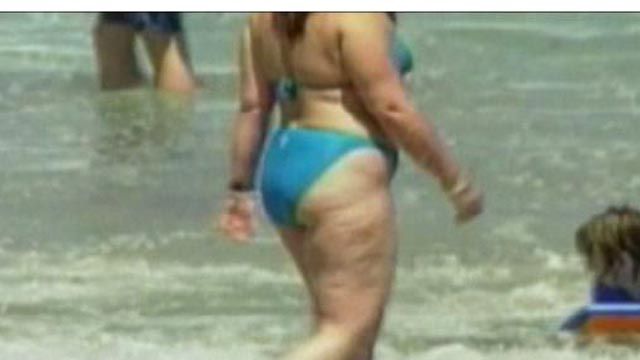 What Is Cellulite?
