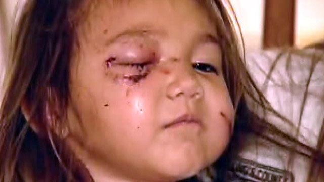 Pit bull bites toddler's face in Hawaii