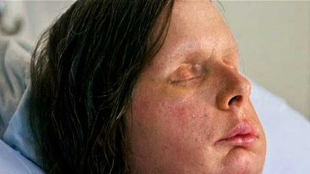 Chimp Attack Victim Gets New Face
