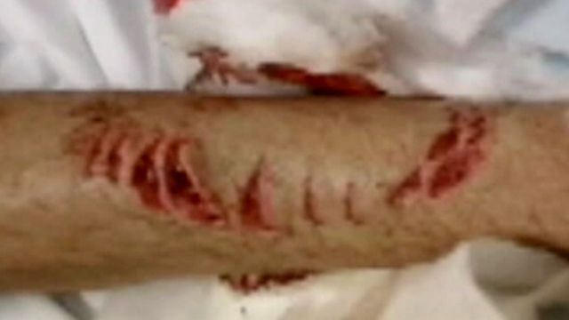 Teen Attacked by Shark and Lives to Talk About It