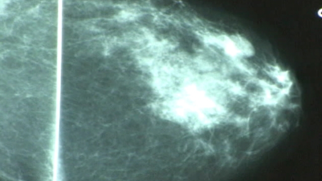 Breakthrough in Breast Cancer Treatment?