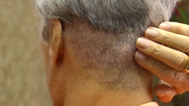 Helping People with Thinning Hair