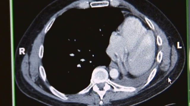 Surviving Lung Cancer with CT Scans