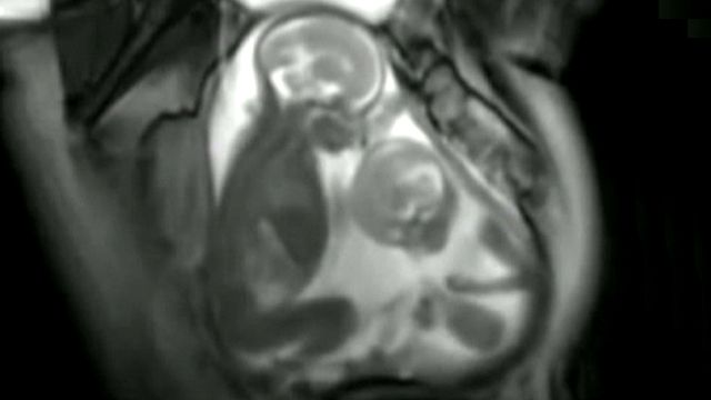 Twins fight for space in womb?