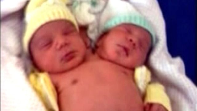Brazilian Woman Births Two-Headed Boy